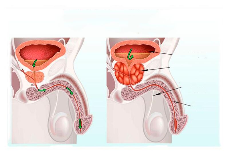 rule and inflammation of the prostate