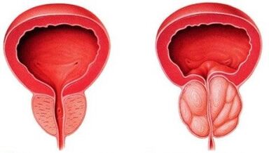 healthy and inflammation of the prostate with prostatitis