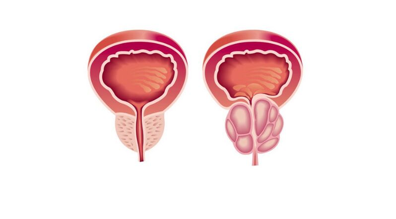 comparison of normal and diseased prostate